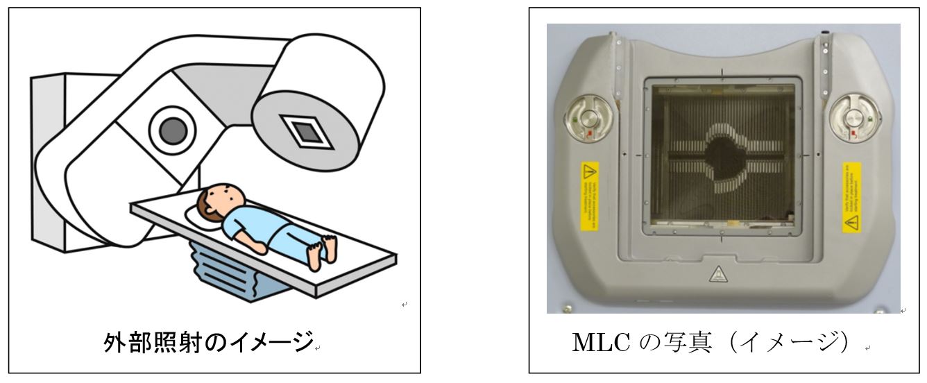放射線治療の一覧 | 一般の方へ | 一般社団法人 熊本県放射線技師会